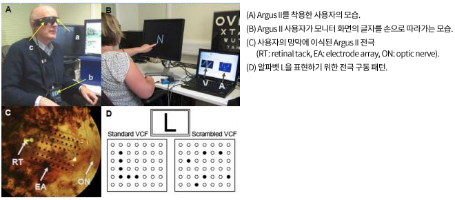 인공 망막 적용